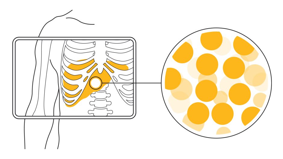 Innovative Yttrium-90 Radioisotopes Revolutionize Liver Cancer 