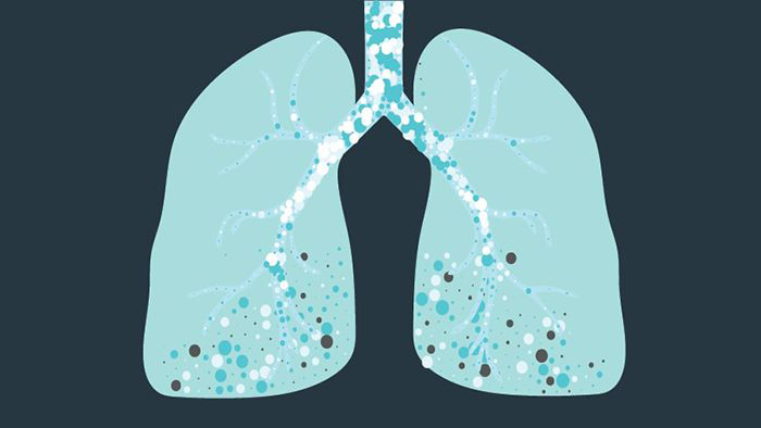 Blocking the Molecular Source of Idiopathic Pulmonary Fibrosis ...