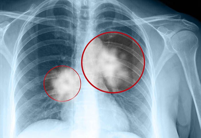 X-Rays First Used to Detect Cancer