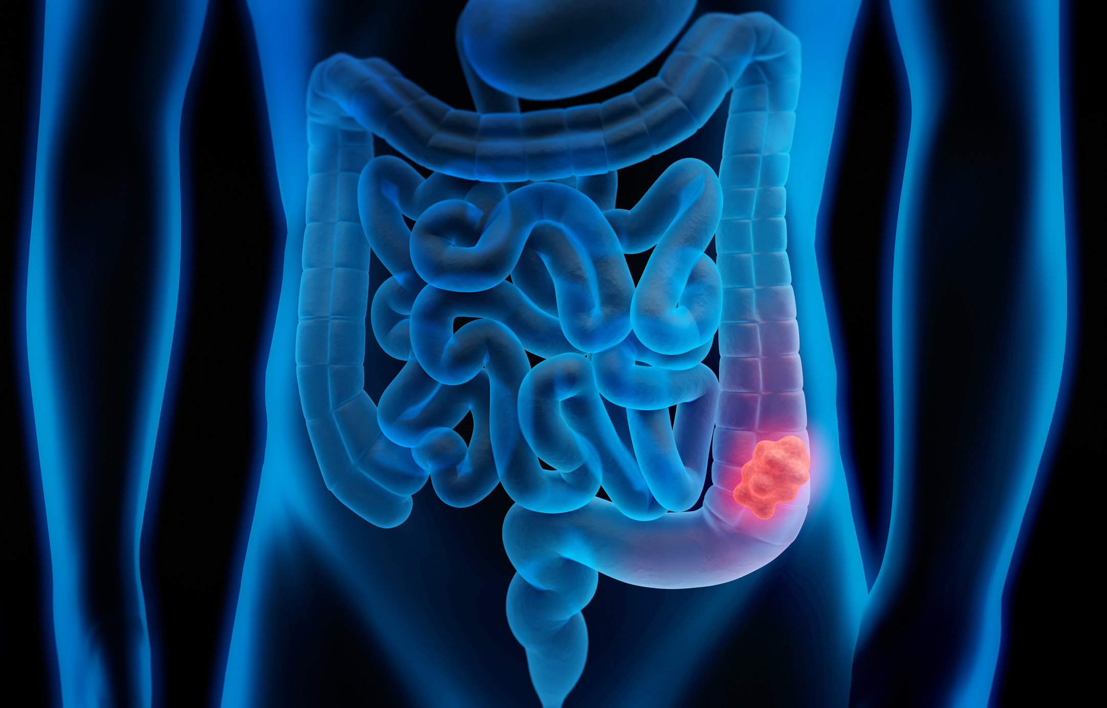 Why Are Colorectal Cancer Rates Rising Among Younger Adults ...